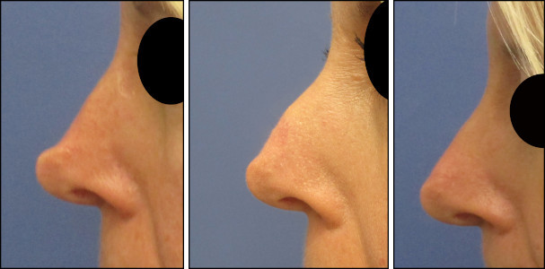 rhinoplasty